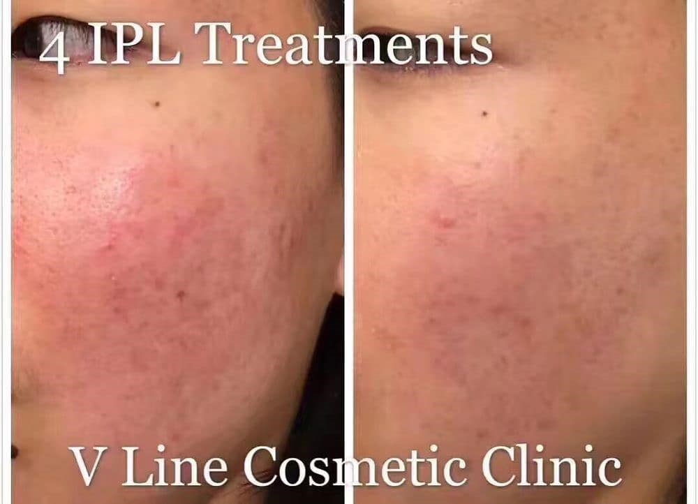 IPL skin rejuvenation for the treatment of redness from acne scars done at VLine Cosmetic Clinic Toronto.